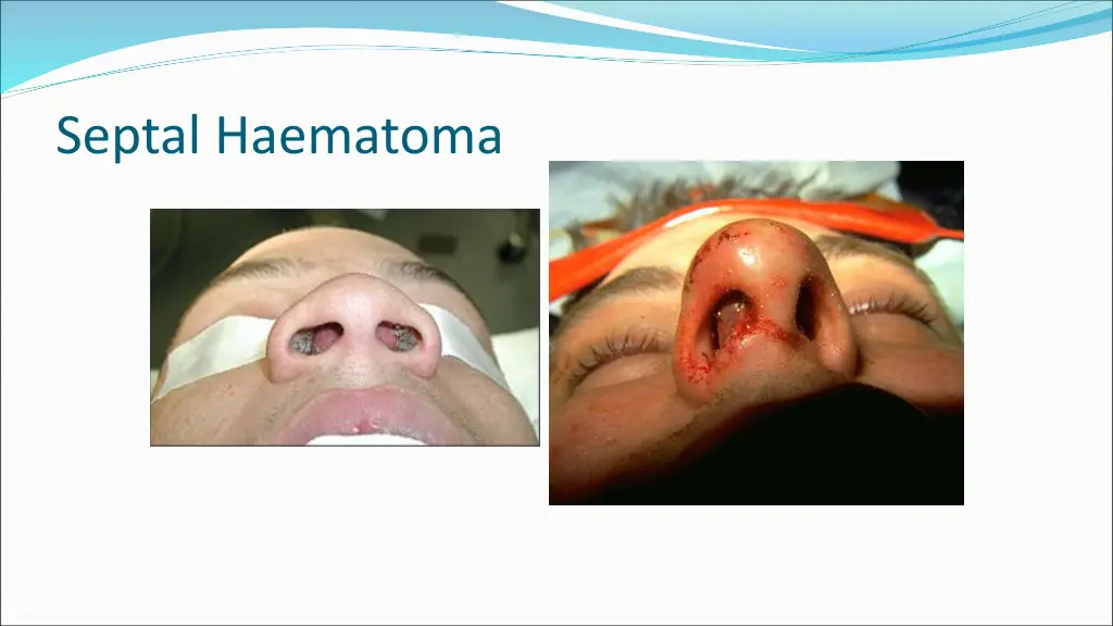 septal haematoma