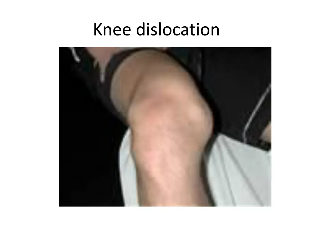 knee dislocation 1