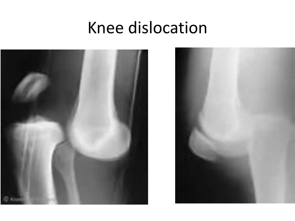 knee dislocation