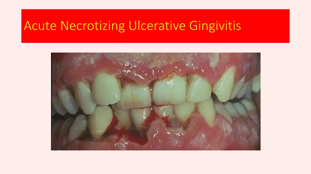 acute necrotizing ulcerative gingivitis