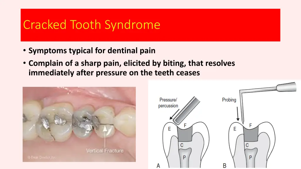 cracked tooth syndrome