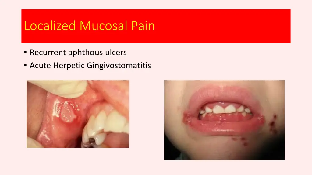 localized mucosal pain
