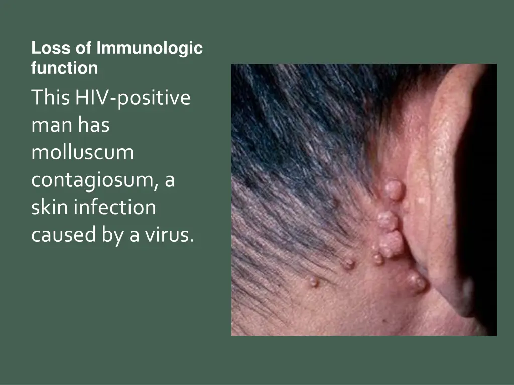 loss of immunologic function this hiv positive