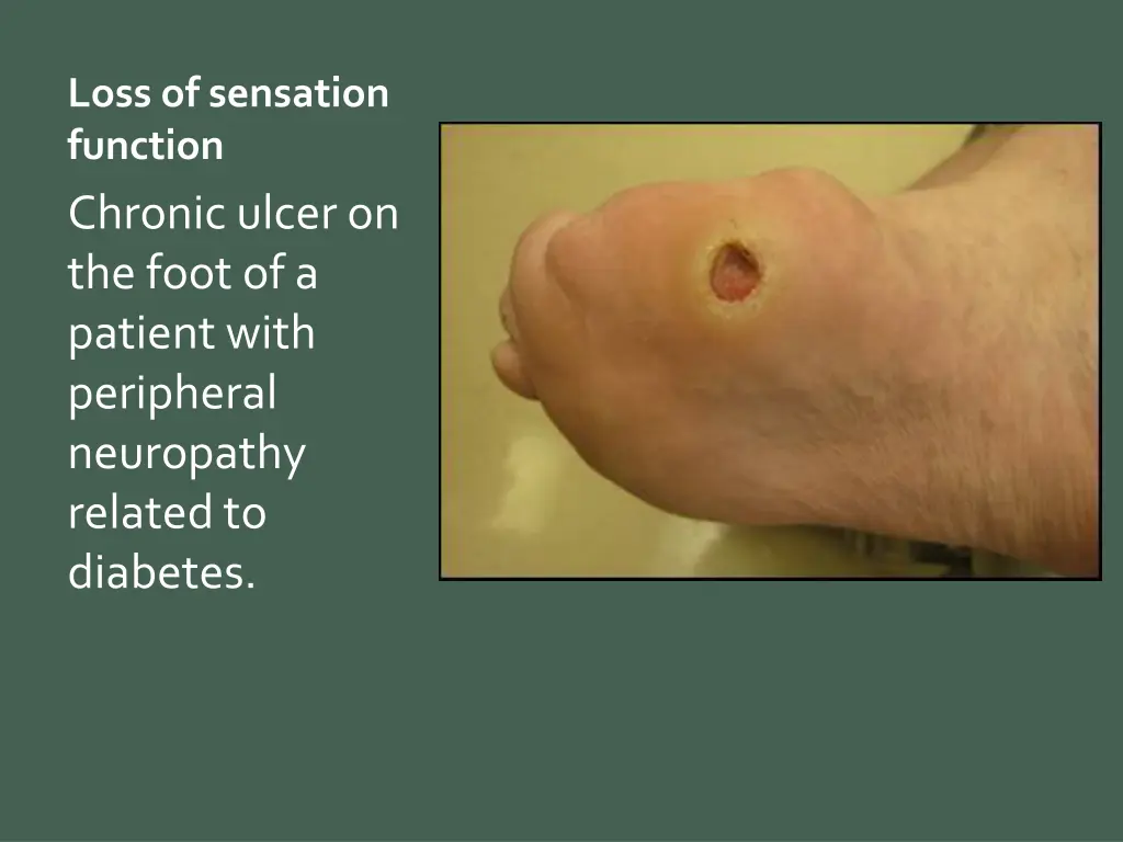 loss of sensation function chronic ulcer
