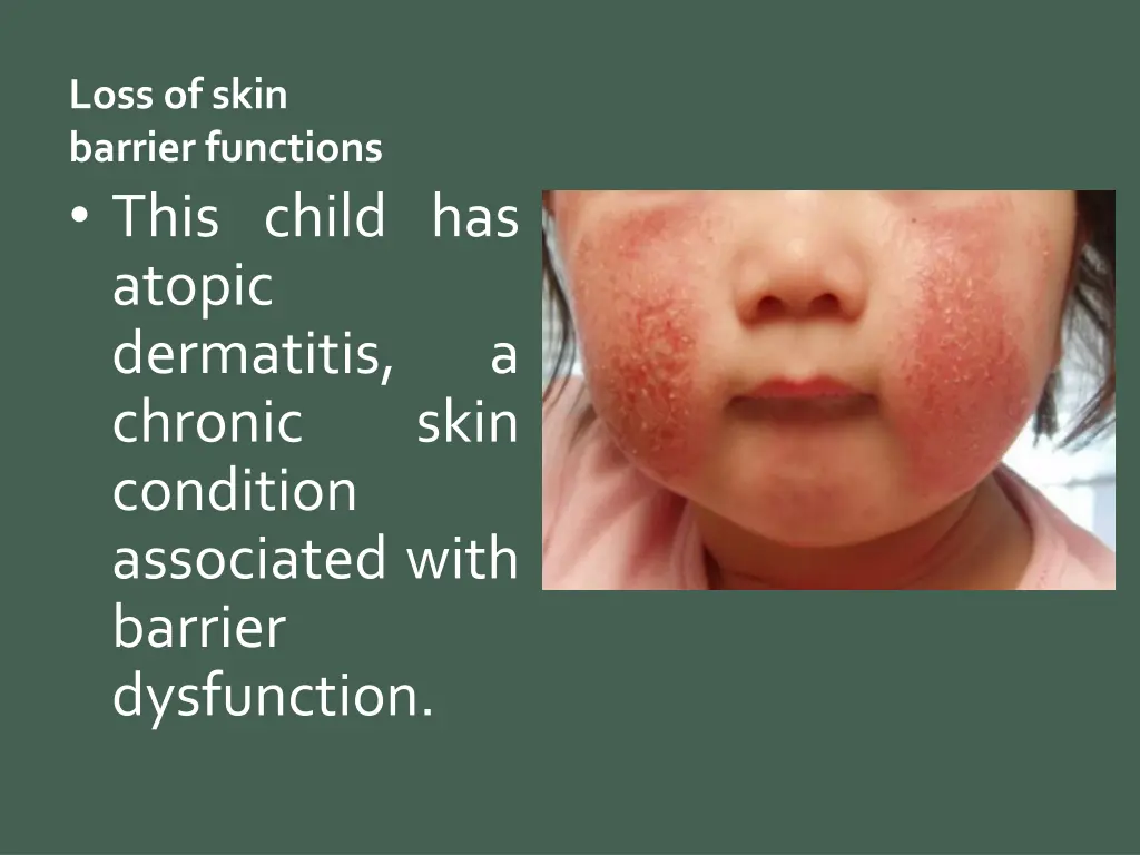 loss of skin barrier functions this child
