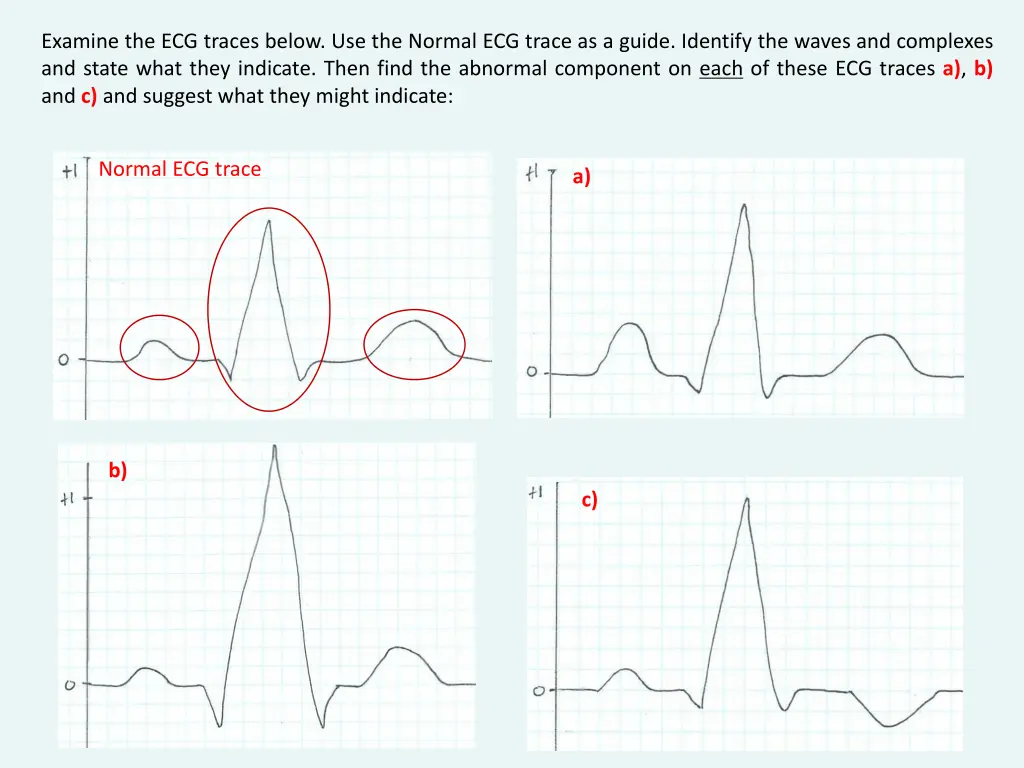 examine the ecg traces below use the normal