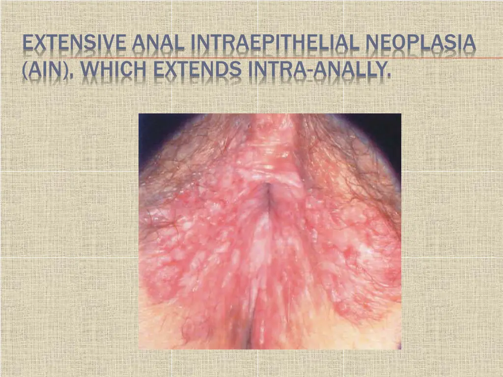extensive anal intraepithelial neoplasia