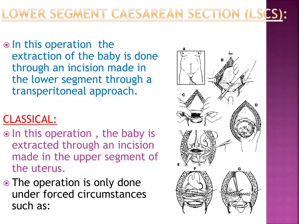 lower segment caesarean section lscs