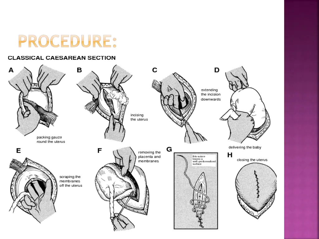 procedure