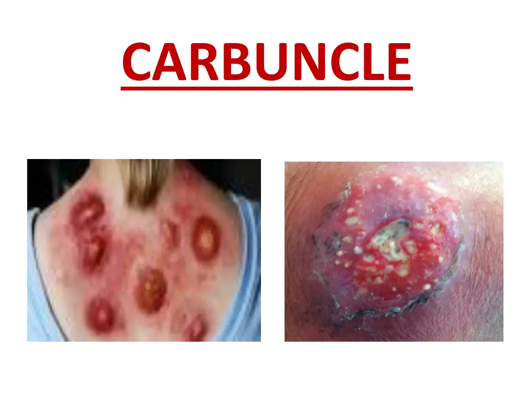 carbuncle