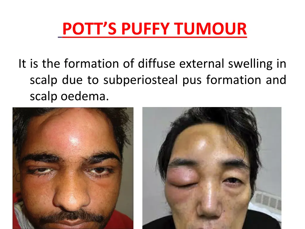 pott s puffy tumour
