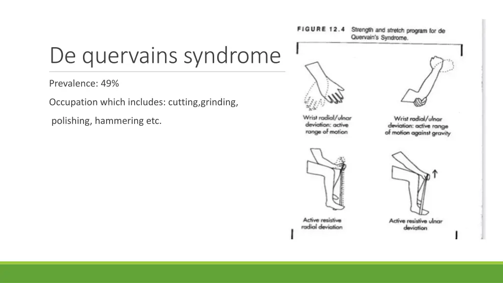 de quervains syndrome