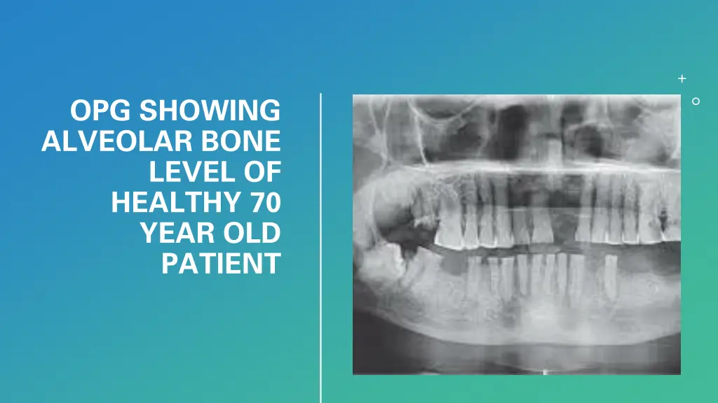 opg showing alveolar bone level of healthy