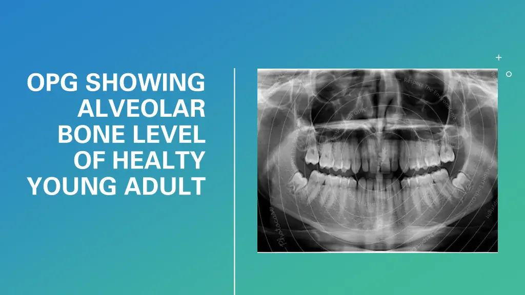 opg showing alveolar bone level of healty young