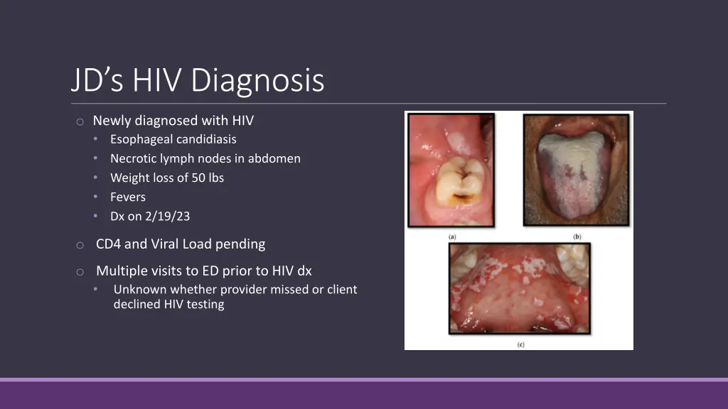 jd s hiv diagnosis