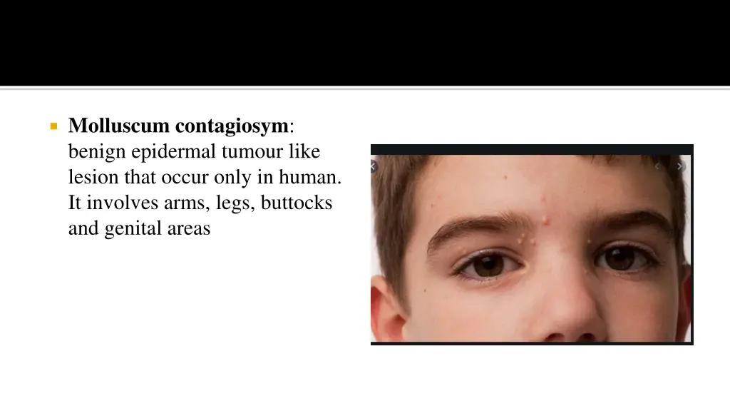 molluscum contagiosym benign epidermal tumour