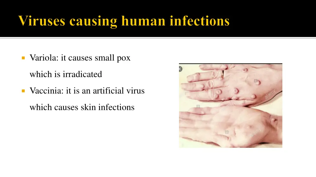 variola it causes small pox