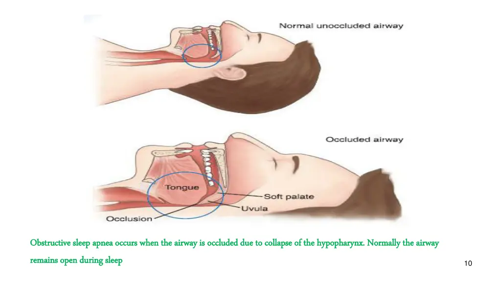 obstructive sleep apnea occurs when the airway