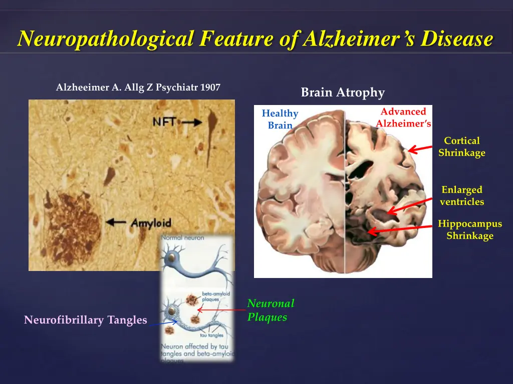 neuropathological feature of alzheimer s disease