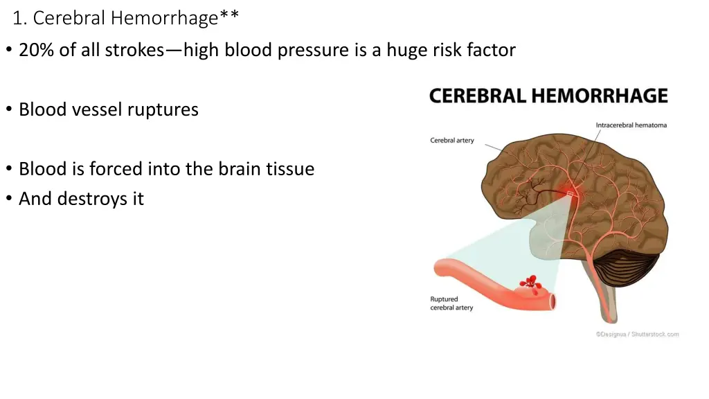 1 cerebral hemorrhage 20 of all strokes high