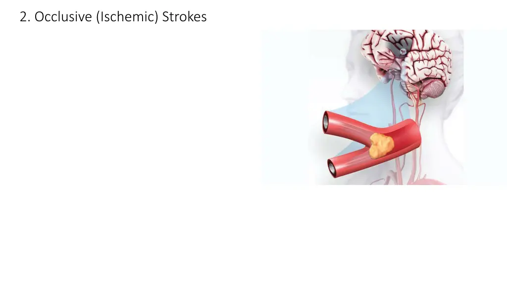 2 occlusive ischemic strokes