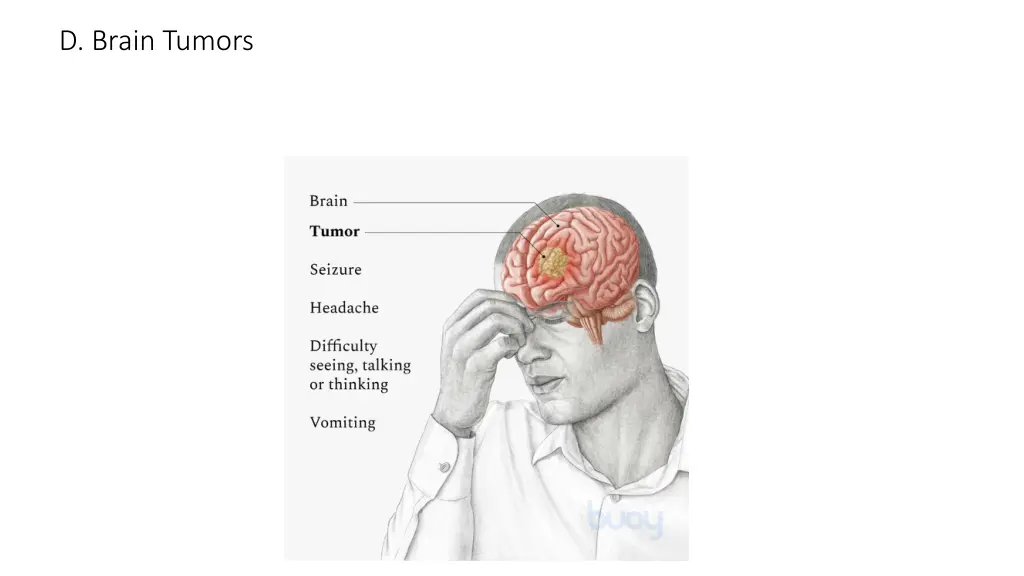 d brain tumors