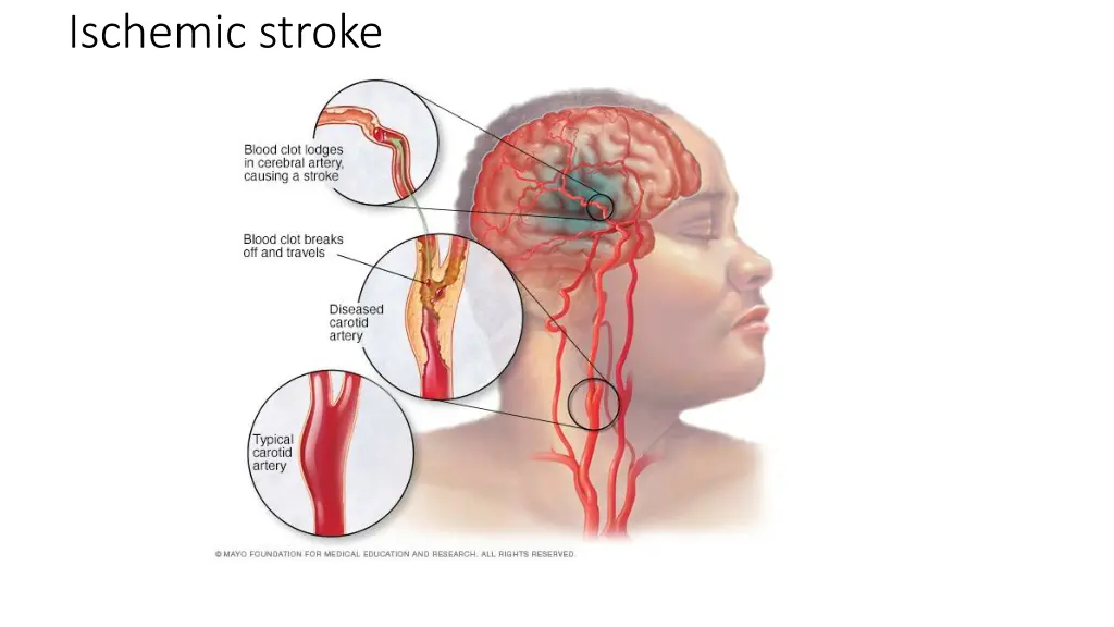 ischemic stroke