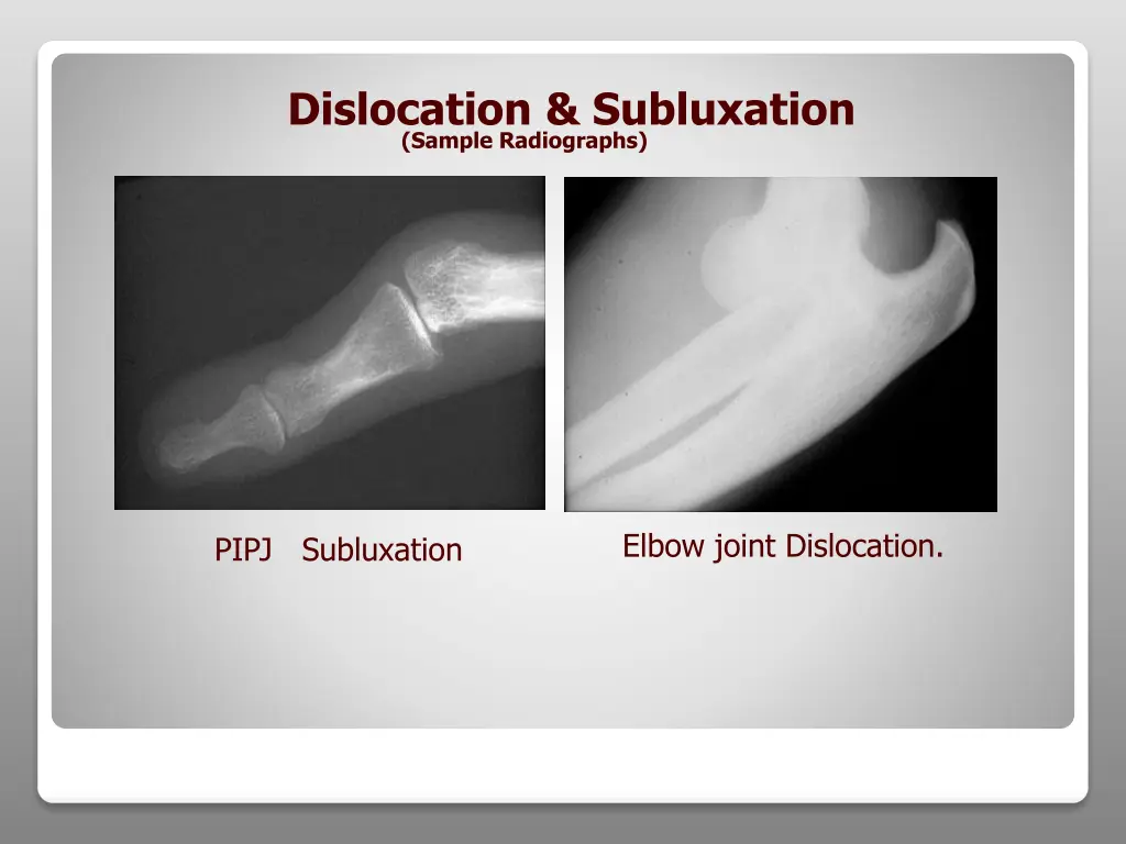 dislocation subluxation sample radiographs
