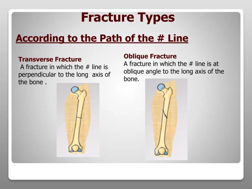 fracture types 2