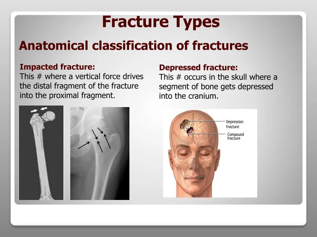 fracture types 4