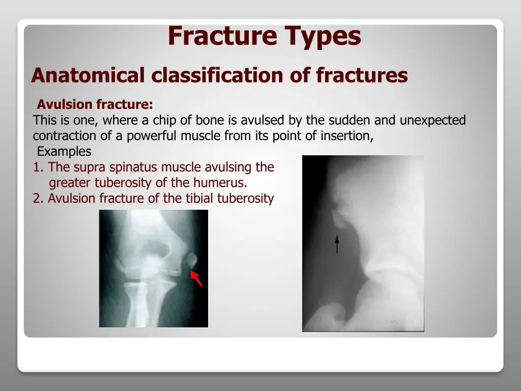 fracture types 5