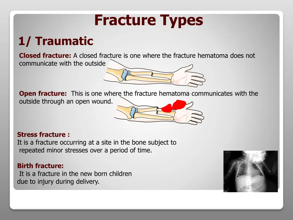 fracture types
