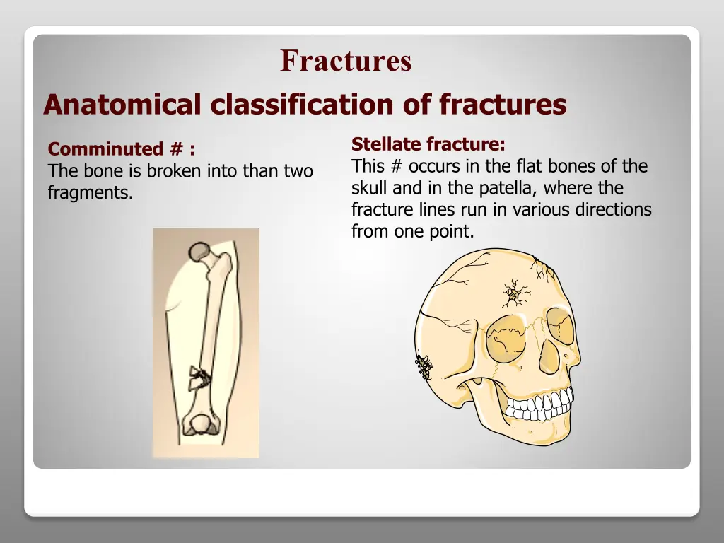 fractures