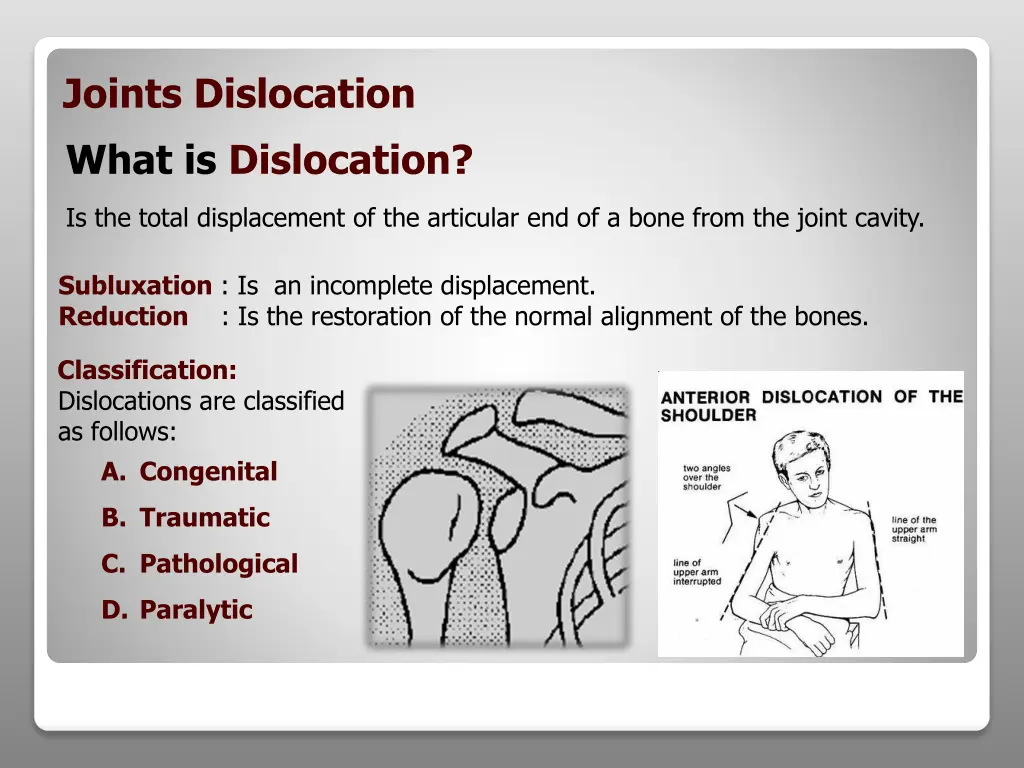 joints dislocation