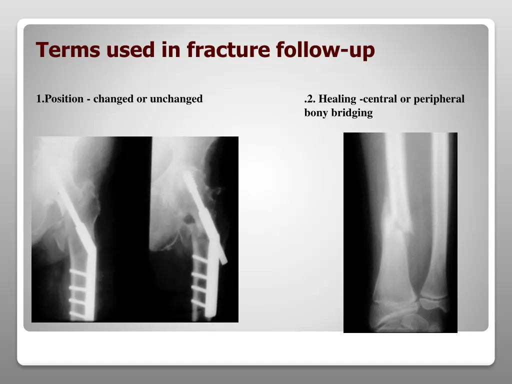 terms used in fracture follow up