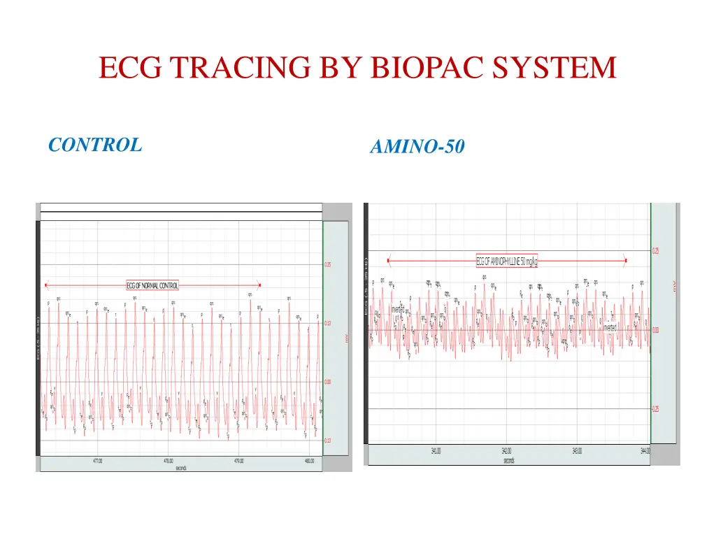 ecg tracing by biopac system