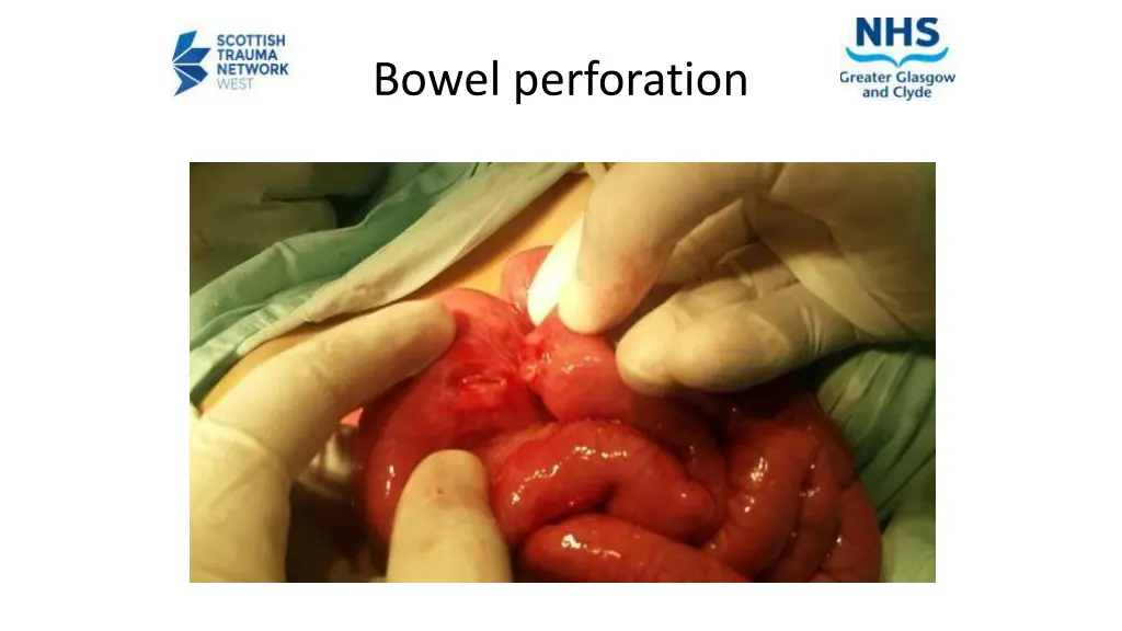 bowel perforation