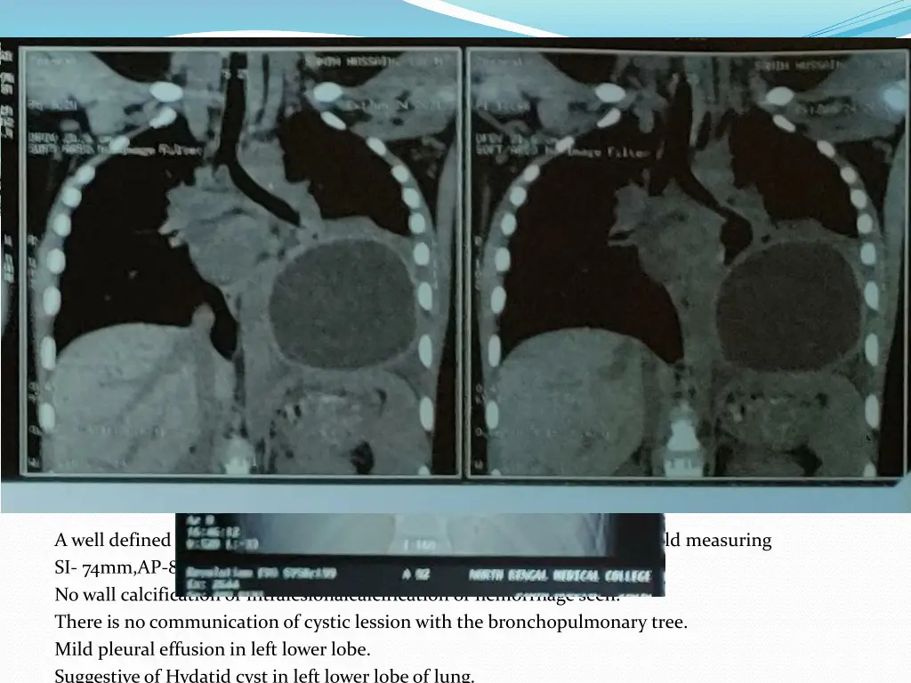 hrct thorax