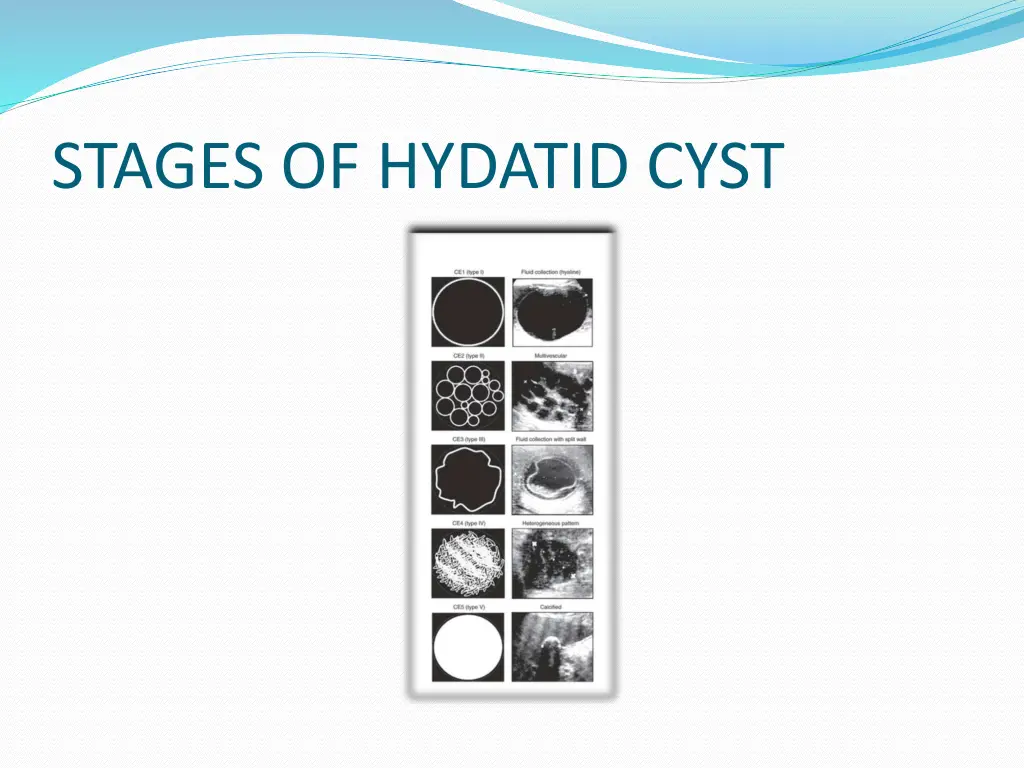stages of hydatid cyst