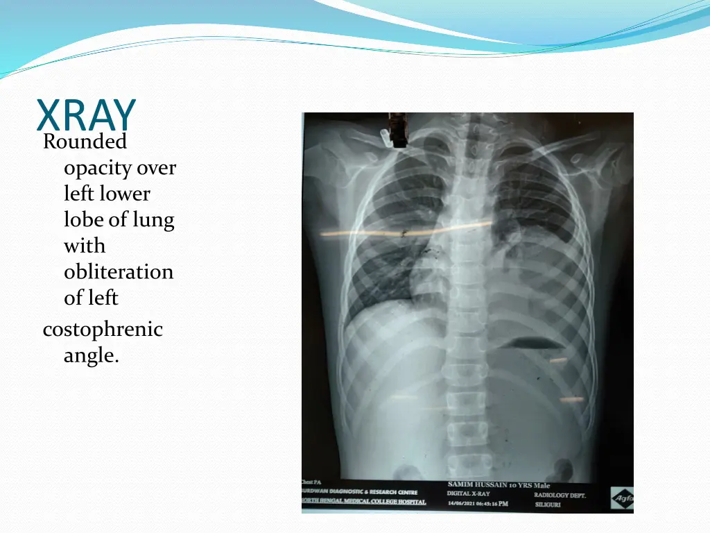 xray rounded opacity over left lower lobe of lung
