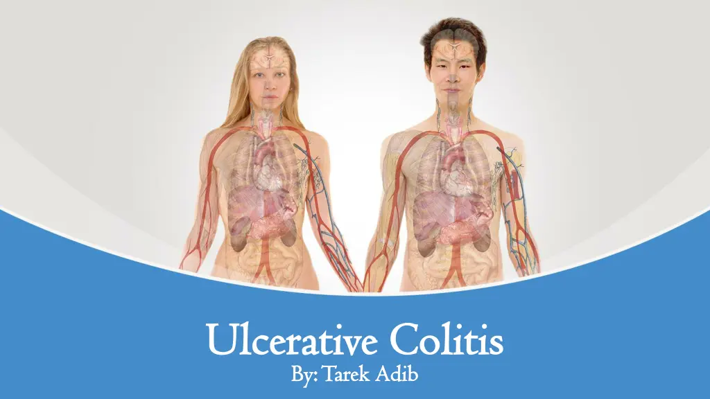 ulcerative colitis ulcerative colitis