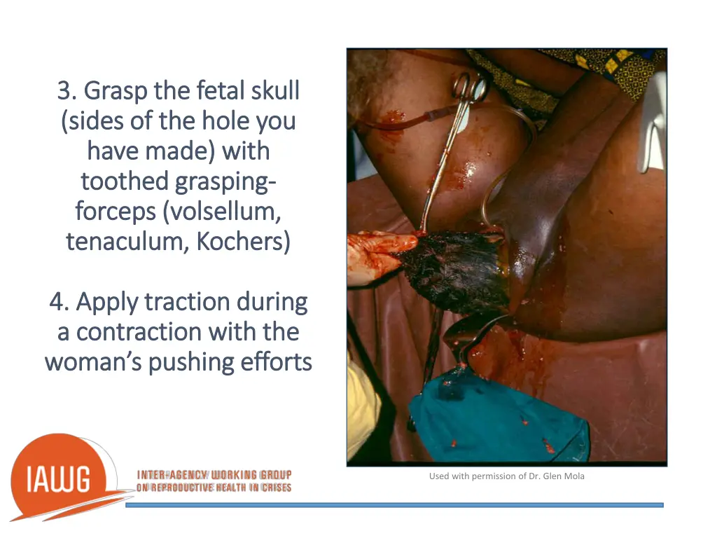 3 grasp the fetal skull 3 grasp the fetal skull