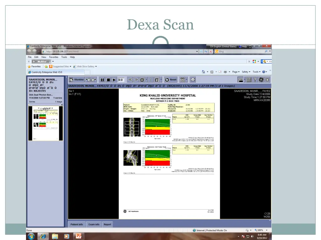 dexa scan