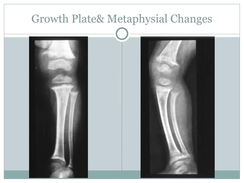 growth plate metaphysial changes