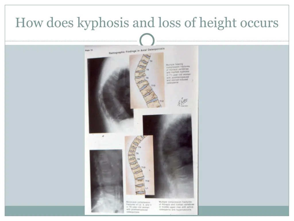how does kyphosis and loss of height occurs
