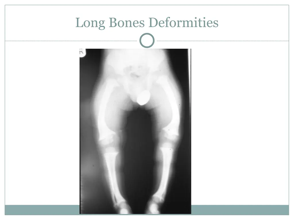 long bones deformities