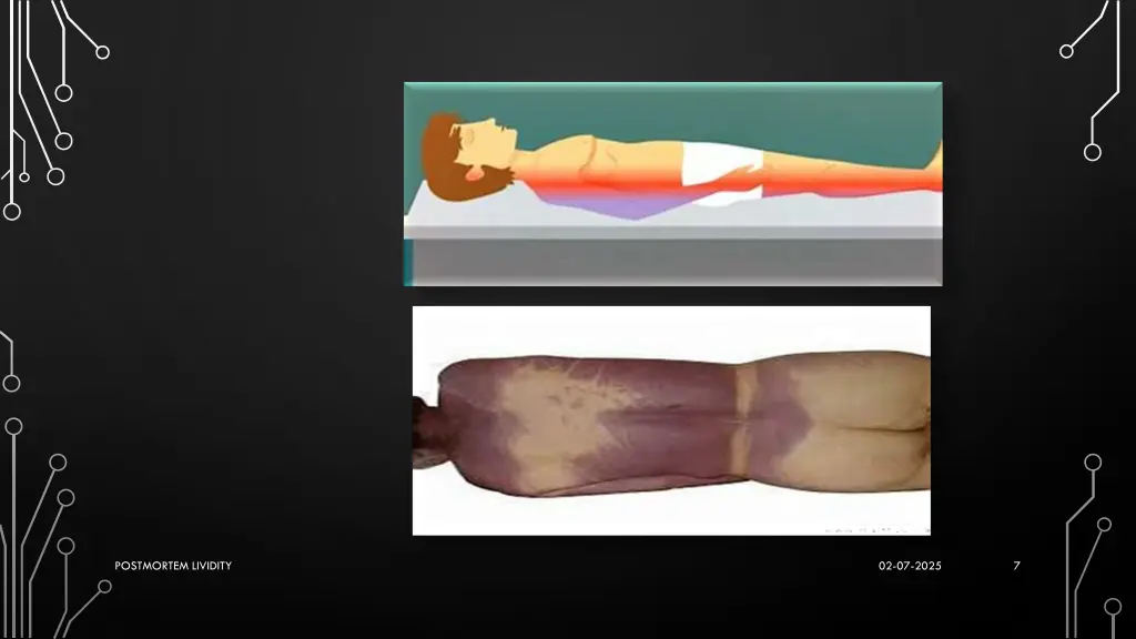 postmortem lividity 2