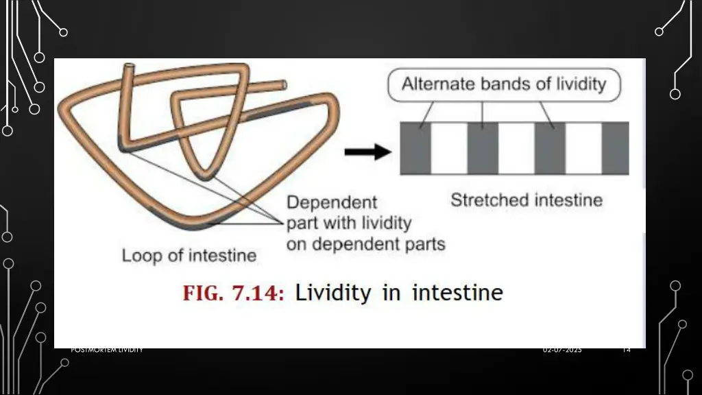 postmortem lividity 4