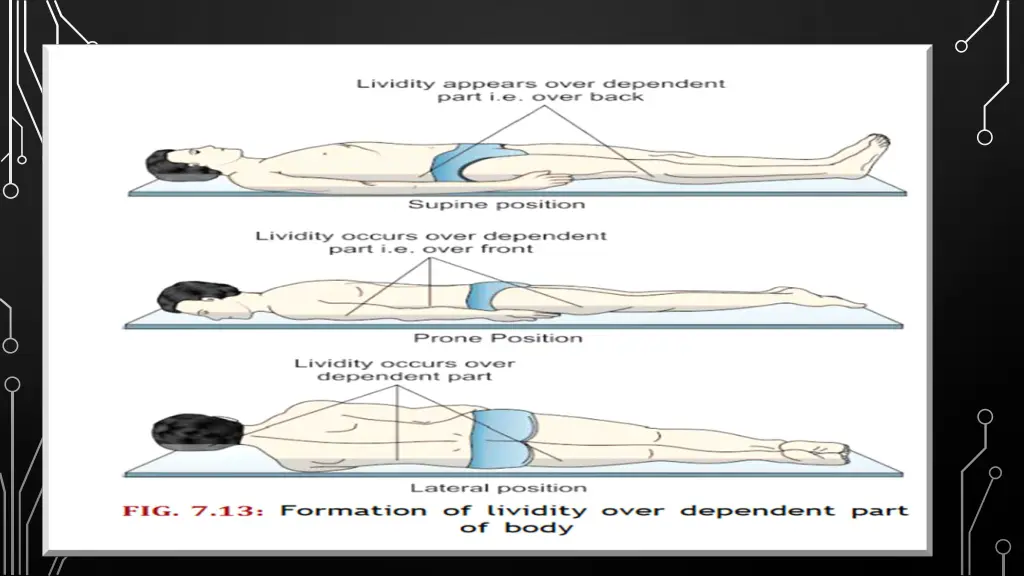 postmortem lividity 5