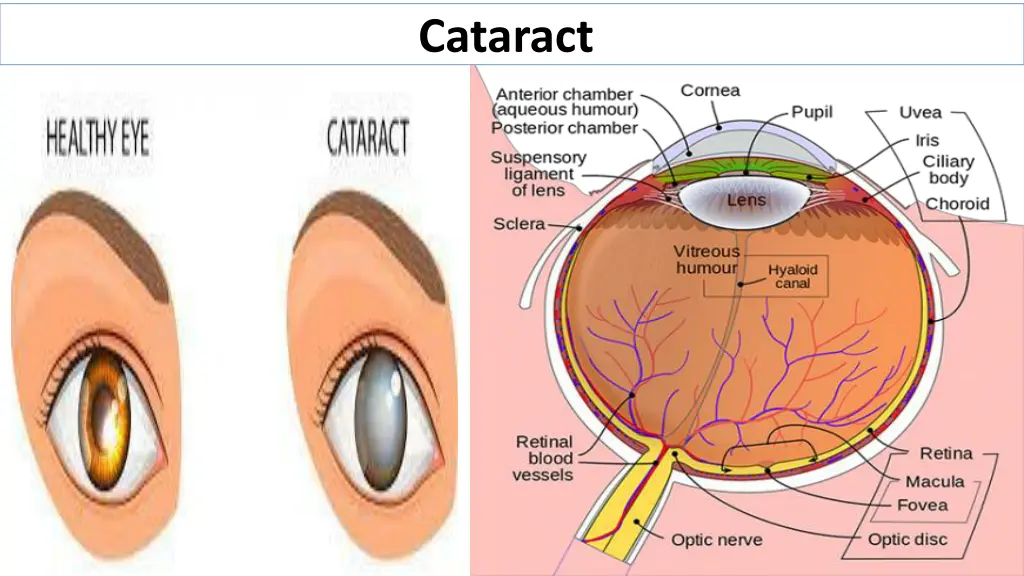 cataract